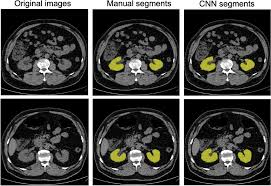 Kidney CNNs